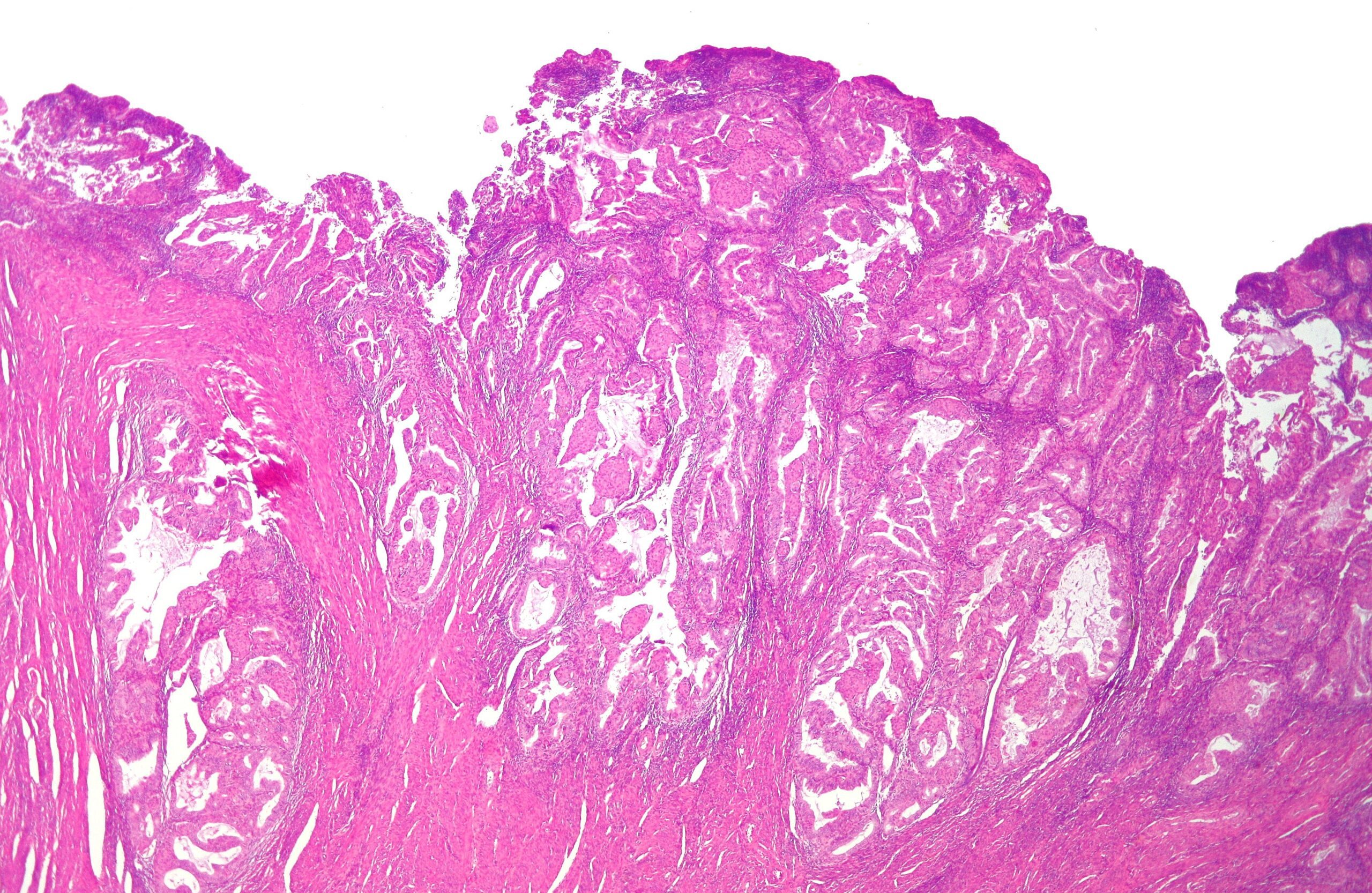 nouveau traitement pour le cancer de l'endomètre